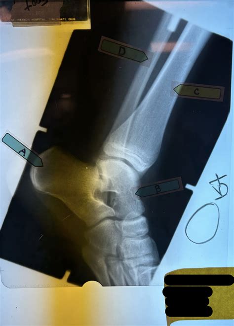 Ankle X Ray Diagram Quizlet