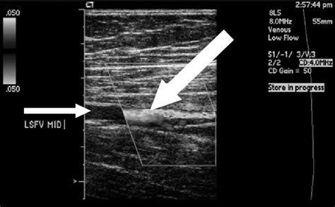 Blood Clot In Leg Ultrasound