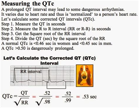 Interval QT | INA - ECG