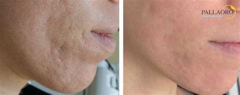 Cicatrici D Acne Quale Laser Scegliere Clinica Pallaoro