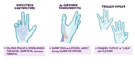 Smith’s Fracture: What Is It, Difference from Colles, and More | Osmosis