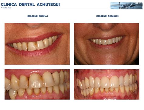 Tratamiento Periodontal B Sico Y Carillas O Facetas De Porcelana