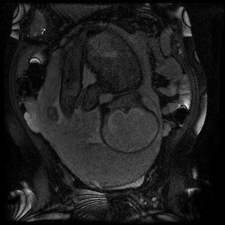 Placenta Accreta Image Radiopaedia Org