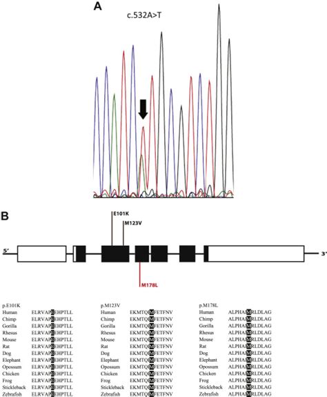 Exome Sequencing Identifies A Novel Variant In ACTC1 Associated With