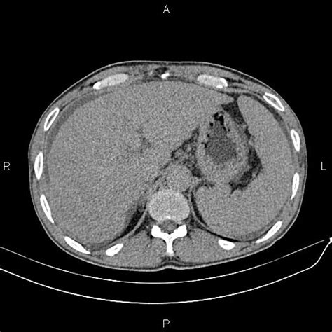 Portal Vein Thrombosis In Cirrhotic Patient Image