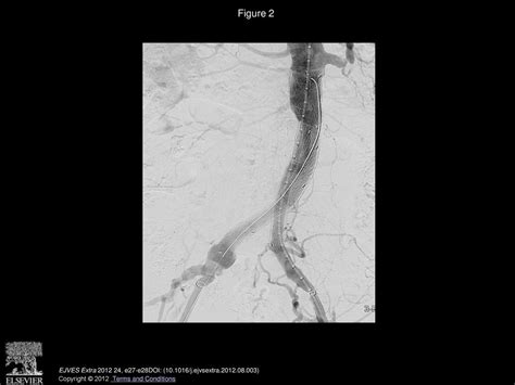 Endovascular Repair Of Aortic Aneurysm Through Bilateral Common Iliac