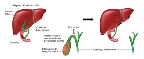 Cirug A Laparosc Pica De La Ves Cula Biliar Cirug A Laparosc Pica Madrid