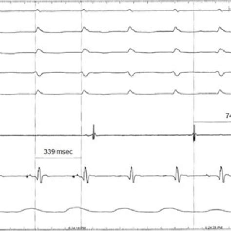 A 12 Lead Surface Electrocardiogram Of The Narrow Complex Tachycardia Download Scientific