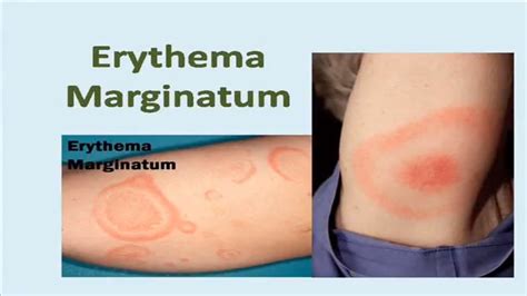 Erythema Marginatum Rash Youtube