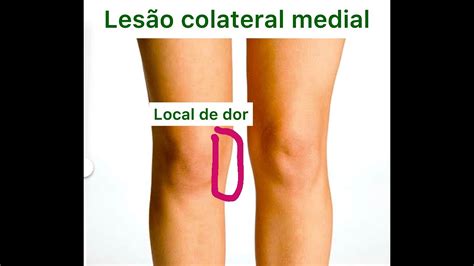 Lesão Do Ligamento Colateral Medial Do Joelho Torção Do Joelho Lesão Ligamentar Youtube