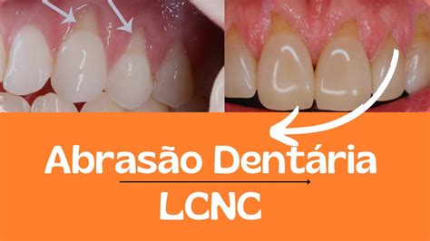 ABRASÃO DENTÁRIA Você sabe o que é Resumos de Odonto YouTube