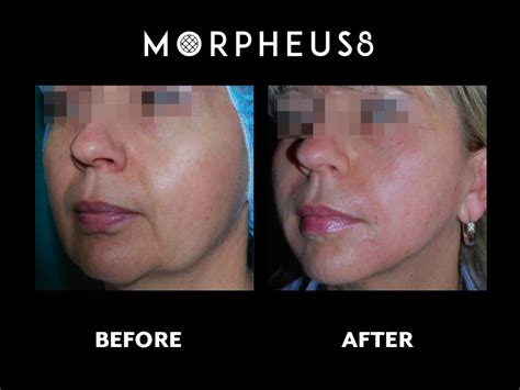 Morpheus8 | PureLife Medi-Spa Wellness and Skincare