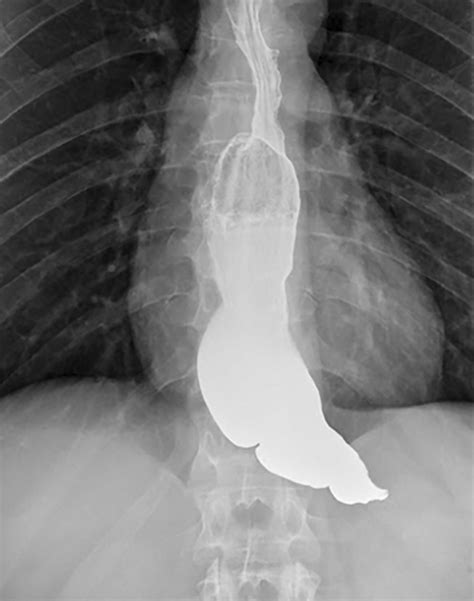 Barium Swallow Study Shows The Typical Mouse Tail Appearance Of The