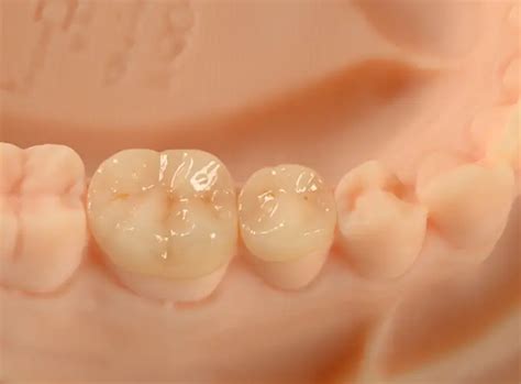 E Max Crown Price Cerec Emax Golden Smile Dental Lab