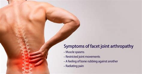 Facet Joint Arthropathy Symptoms Causes Prevention And Treatment