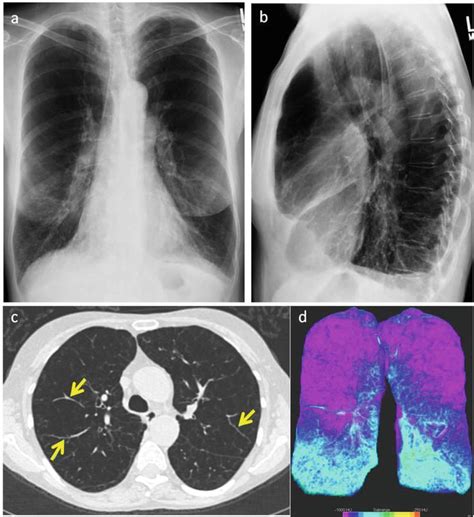 Imaging Of Emphysema A Comprehensive Review Intechopen