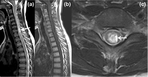 Differentiating Neuromyelitis Optica From Other Causes Of Longitudinally Extensive Transverse