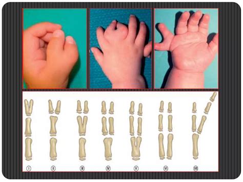 Congenital Hand Anomalies Ppt