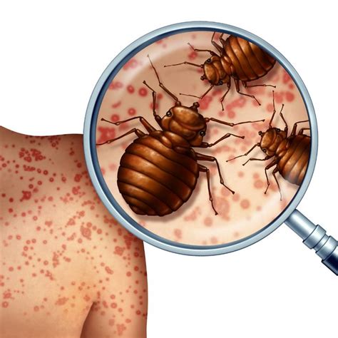 Differences Between Flea Bites And Bed Bugs Shabby Chic Boho Bed Bugs Bed Bug Bites Bed