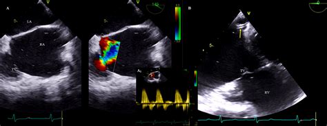 Change In Tricuspid Valve Function After Transvenous Lead Extraction