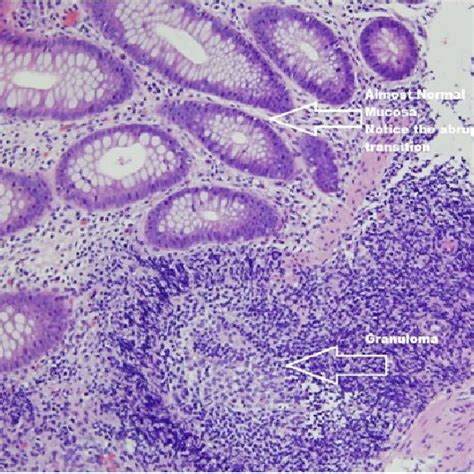 A Normal Colonic Mucosa Download Scientific Diagram