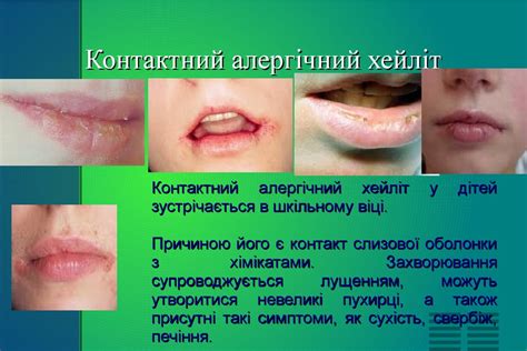 Хейліти. Самостійні хейліти. Симптоматичні хейліти, сучасний погляд ...