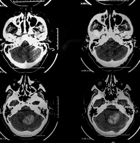 Brain Tumor Surgery | Gulf Coast Brain and Spine Center