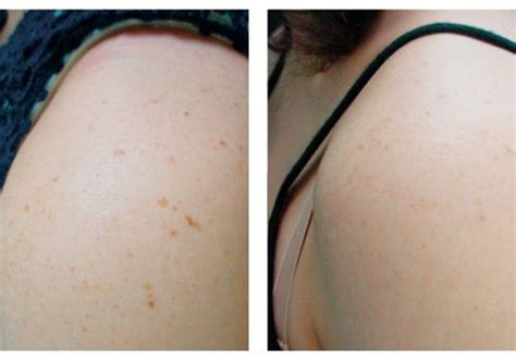 Laser Skin Rejuvenation Laser Of Arlington