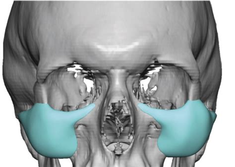 Plastic Surgery Case Study Custom Midface Implant Replacements For