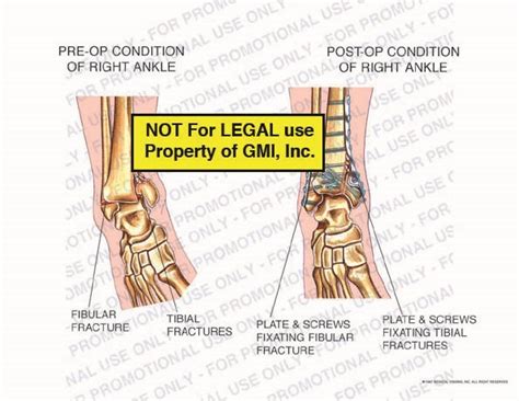 Pre Op Vs Post Op Condition Of Right Ankle 98026c27a Generic Medical Legal Exhibits A