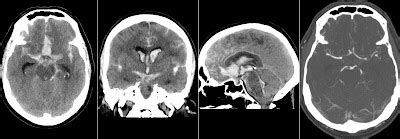 Anterior Communicating Artery Aneurysm Rupture