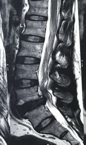 Lumbar Spondylosis – Best Spine Surgeon in Mumbai | Dr. Amit Sharma