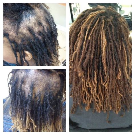 Thinning Dreads Balding Hair Alopecia Look Here Hollywood Bald