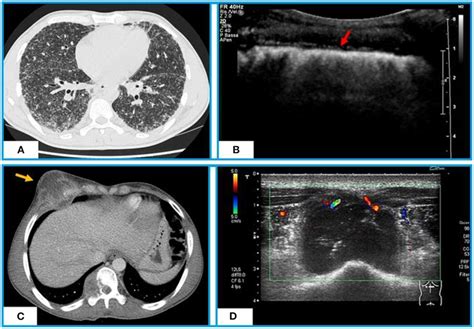 Chest Ct And Tus Appearance Of Miliary Tb A Axial Ct Scan Shows Download Scientific