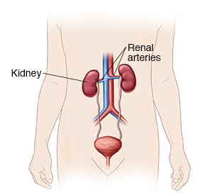 Renal Angiography Saint Luke S Health System