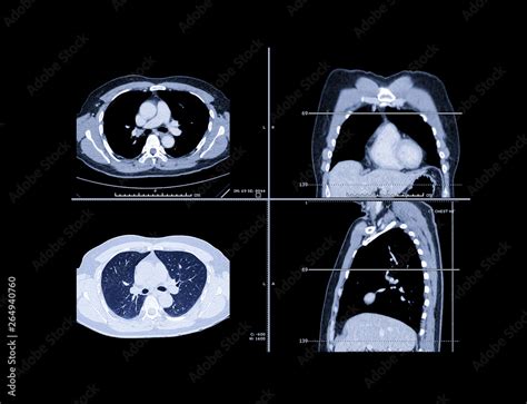 Sagittal Ct