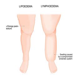 Lymphedema leg swelling Royalty Free Vector Image