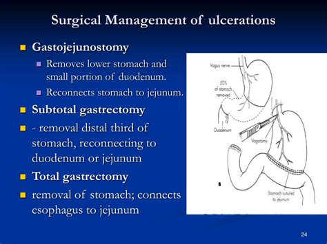 Ppt Care Of Patient With Gerd And Peptic Ulcer Powerpoint Presentation