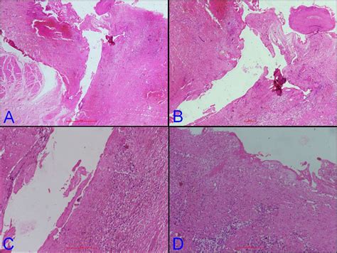 Collaural Fistula With Bony Tract A Surgical Challenge Bmj Case Reports