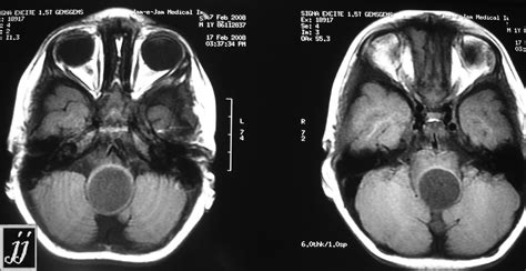 Brain Stem Tumor Radiopaedia