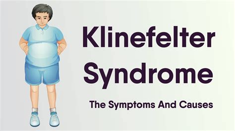 Klinefelter Syndrome Physical Features