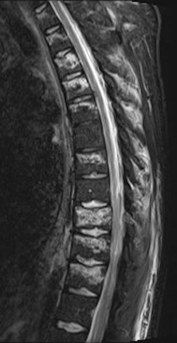 Fractura Vertebral Osteopor Tica Dr Jose Navarro