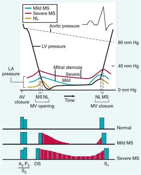 Penyakit Stenosis Katup Mitral – Kedokteran – Caiherang