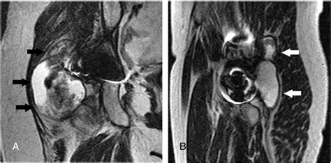 Prevalence Of Pseudotumor In Patients After Metal On Metal Hip Arthroplasty Evaluated With Metal