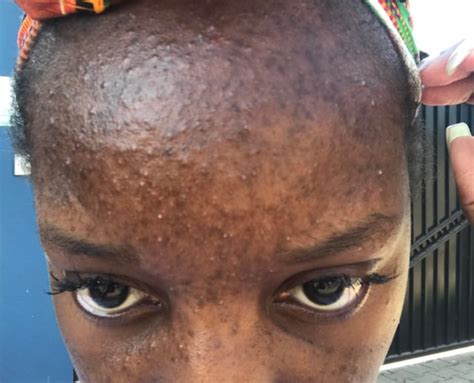 Update On The Hyperpigmentation And Malassezia That Tried To Kill My