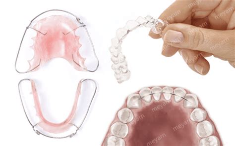 Retainers After Orthodontic Treatment Why Theyre So Important The