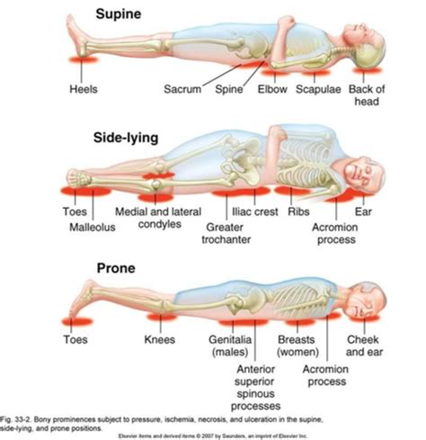 Week 6 Pressure Ulcers Pathophysiology Detection And Prevention