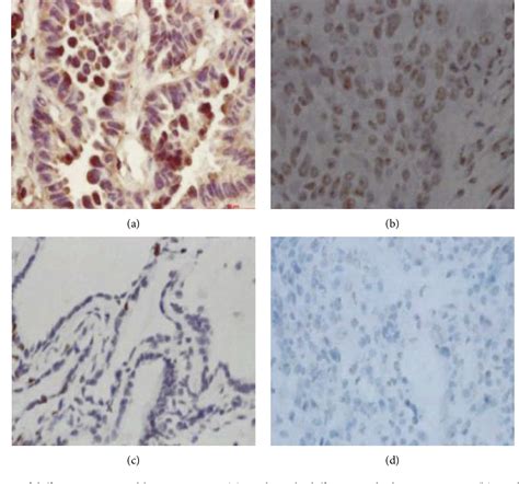 Figure From The Expression Of Hnrnp A B In Benign And Malignant