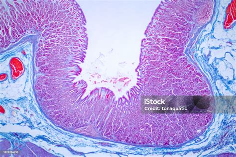 Colon Biopsy From The Colonoscopy The Pathology Report Describes Normal