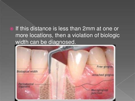 Biologic width - Importance in Periodontal and Restorative Dentistry